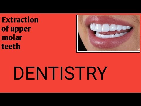 Extraction of upper molar teeth #dentistry #extraction #uppermolarteeth