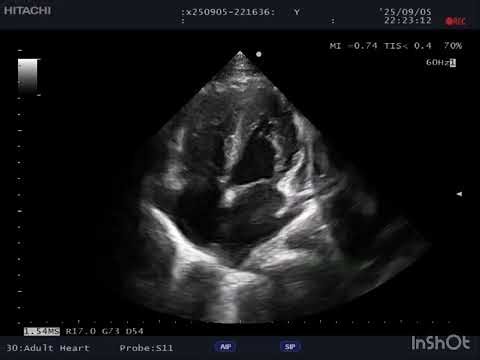 Case 267: POCUS Detects Pre-Tamponade in a 20-Year-Old | Emergency Case