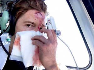 Shaun White shares footage of crash that led to in 62 stitches in face