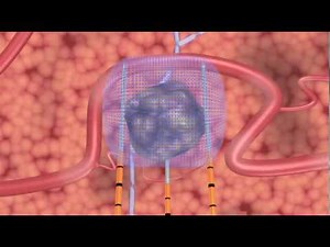 URMC introduces NanoKnife technology for soft-tissue tumors