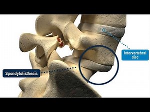 Core Stability for Anterolisthesis: Basic Exercises to Start With | Proactive Physiotherapy