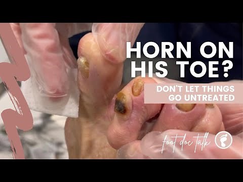 Horn on His Toe!