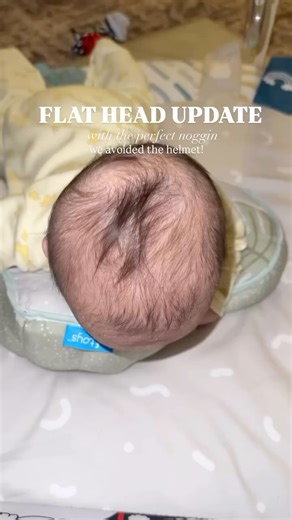 The Perfect Noggin | The Noggin Doctor on Instagram: "@itstrishseggay and her baby AVOIDED THE HELMET!! The physician was impressed by how much her baby’s head rounded out! Trish wrote: “Thank you @theperfectnoggin!! You saved my baby from wearing a helmet 23 hours a day and also saved us money!!” This is why we do what we do 😊😊😊 #plagiocephaly #momhacks #plagiocephalyawareness #tummytimeactivities #tummytimefun #rawmotherhood #realmotherhood #motherhoodtips #southjerseymoms #fourmonthsold"