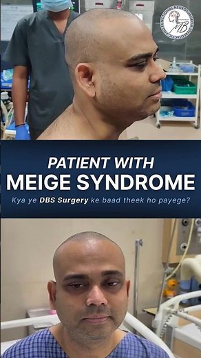 Meige Syndrome Patient Before DBS Surgery | Neurological Disorder Treatment by Dr. Manish Baldia