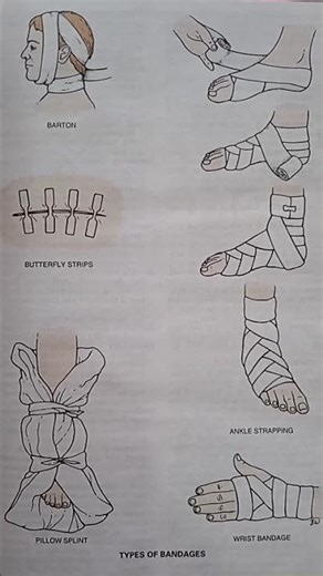 TYPES OF BANDAGES
