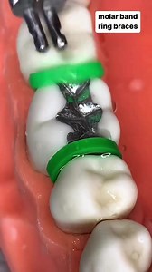 Separators and Molar Band. #Dentistry #LearningTips #BitesnBraces | Bites & Braces Dental
