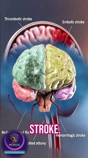 🧠 What is a Stroke? The "Brain Attack" Explained