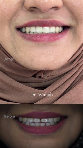 Open Bite Correction with Braces and Myofunctional Treatment