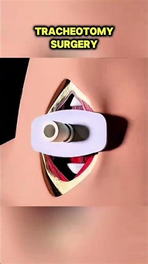 Tracheotomy Surgery Explained (3D Animation) #tracheotomy #airwaysurgery #ent #medical3d #3danimatio