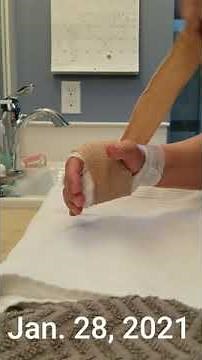 Trigger Finger Surgery One Week Later