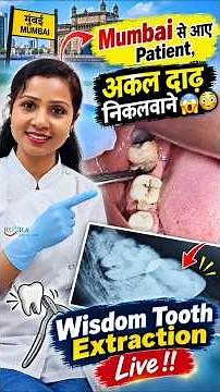 Mumbai से आए Patient अकल दाढ़ निकलवाने 😲 |फंसी हुई अकल दाढ़ 😱 फिर ऐसे निकाला! |Wisdom Tooth #shorts