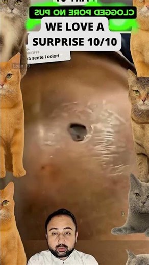 Large Blackheads Extraction Big Cystic Acne Blackheads&Whiteheads Removal Pimple Popping #1136 2026