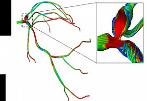 Non-Invasive Diagnostics for Coronary Artery Disease - Center for Computational and Digital Health Innovation