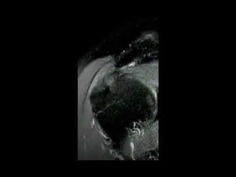 MRI Interpretation: Full Thickness RCT Diagnosis