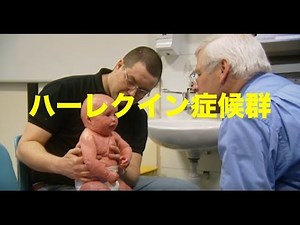 【衝撃】ハーレクイン症候群を持って生まれてきた姉妹