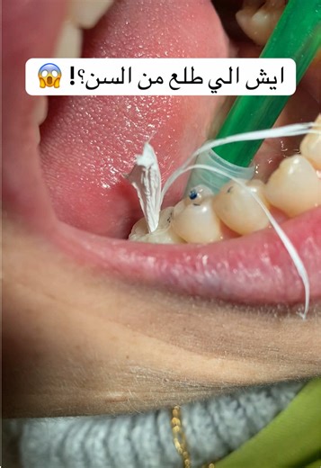 ‏ايش طلع من السن؟ 🤔 #اكسبلور #تقويم #الرياض #fyp #اسنان | teflon tape