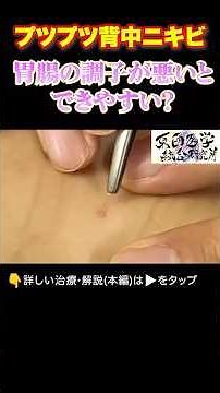 【ニキビ 角栓粉瘤】ニキビ角栓鍼治療 20年来の背中ニキビは鍼灸治療で改善するのか？【鍼灸院ブレア銀座虎ノ門・元町 東西医学統合研究所】