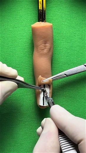 Nail Matrix Biopsy for Melanonychia: Procedure and Symptoms Explained