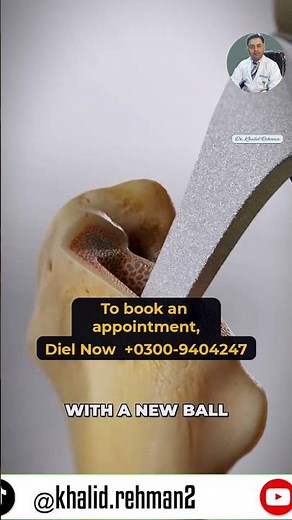 Total Hip Replacement Surgery Explained | 3D Medical Animation #medical #3danimation