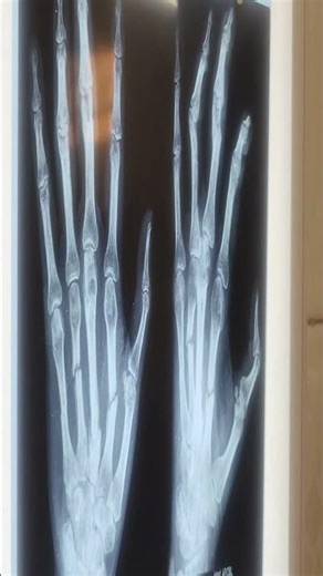 Crush Injury Left Hand – K-Wire Fixation & Recovery | 35-Year-Old Male | Dr. Neelabh