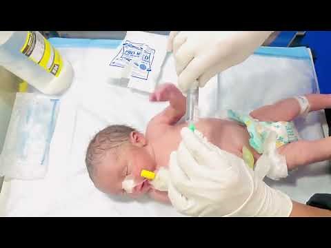 Safe NG Tube Insertion for Meconium-Stained Baby in NICU