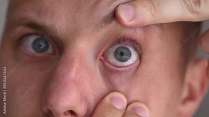 Something got into the eyeball. The man opened his eyes wide. Eyeballs close-up. Bursting blood vessels in front of the eyes close-up