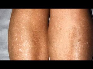 Effective treatment for White patches, White spots, Vitiligo & Uneven Skin Complexion #whitepatches