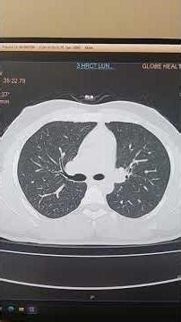 #radiology#ct thorax#medicaltranscription #