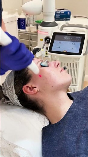 Laser Treatment for Active Acne - Clear Skin Results & How It Works