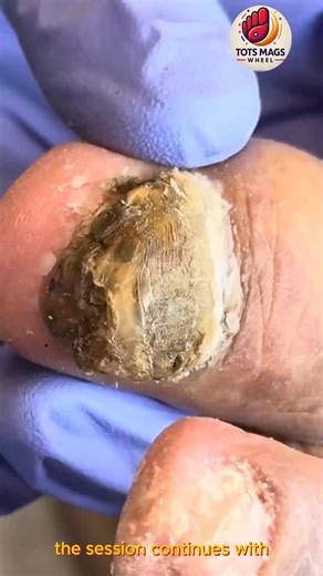 27K views · 268 reactions | Runner Ingrown Guard: Effective Clean Nail Care Steps #ThickToenailCare #FootWellnessUSA #SafeNailCare | Tots Mags Wheel | Facebook