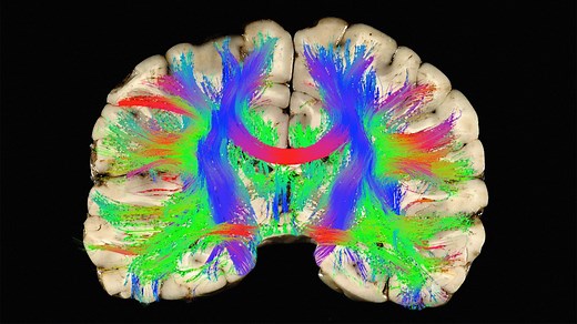 Why helmets don't prevent concussions -- and what might