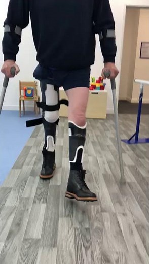 Carbon Fibre Orthotics for a Post Polio Patient