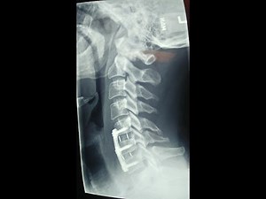 6 Weeks Post ACDF | Mistakes after ACDF