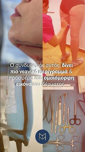 ✨ Laser Lift + Λιποαναρρόφηση | Γιατί μαζί κάνουν τη διαφορά;