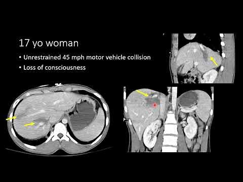 Blunt Abdominal Trauma Part 2 Liver Injury