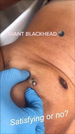 Big Pimple Videos on Instagram: "Follow us ?? @cyst.removal.videos for more pimple popping videos?? #pores #acne #skincare #blackheads #pimples #whiteheads #pimple #blackhead #skin #beauty #blackheadextraction #blackheadremoval #pimplepopping #whitehead #pimplepop #pimplepoppers"