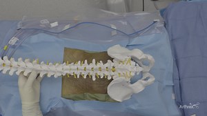 Endoscopic Discectomy at L5-S1