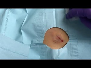 Gory Shoulder Cyst Is Removed