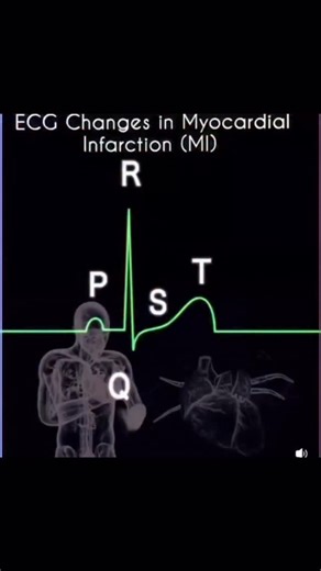 EMS Exam Prep on Instagram: "Good visual of possible leg changes in MI 1. Minutes to ~ 30 mins Hyperacute T waves (tall, peaked) Earliest sign of ischemia 2. 30 mins to a few hours ST- segment elevation (STEMI) Indicates transmural ischemia Possible loss of R wave amplitude 3. Hours to 24 hrs Development of pathologic Q waves (wide/ deep) ST elevation may persist T waves begin to invert 4. Days (1-2 days) T wave inversion becomes prominent ST elevation resolves gradually Q waves deepen 5. Weeks 