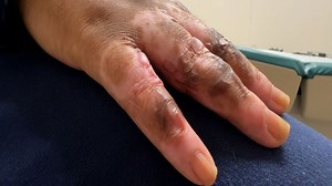 Western New York doctor explains landmark frostbite treatment