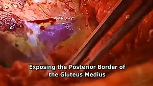 Open Surgical Dislocation for Femoroacetabular Impingement