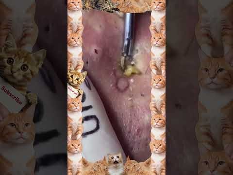 Satisfying Blackhead Extractions to Soothe Your Soul