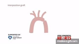 Coarctation of the Aorta: treatment on Make a GIF