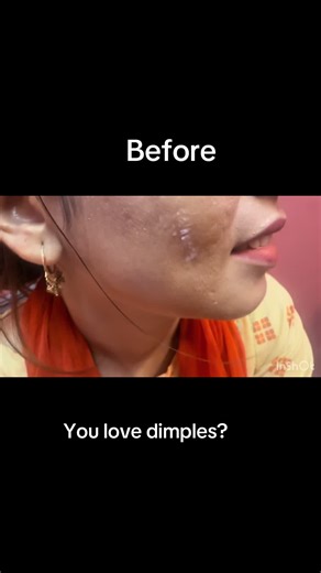 Explore Dimploplasty with Dr. Sidra Aziz