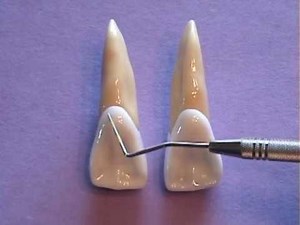 Maxillary Central Incisor - Anatomy