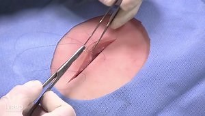 Lacerations and Suturing Techniques: Horizontal Mattress