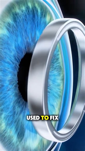 How photorefractive keratectomy surgery is performed (3D Animation) #medical3danimation #3dmedicalanimation #prksurgery #lasersurgery #clearvision | Mix Dancing Events