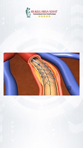 Salam Keluarga Sehat... Hallo Sobat Sehat Sudah tahu apa itu Cath Lab? Catheterization Laboratory (Cath Lab) merupakan prosedur medis untuk mendiagnosis serta mengobati gangguan jantung dan pembuluh darah sebagai tempat dilakukannya kateter jantung atau pemasangan ring. Yuk, simak penjelasan dr. Mustika Mahbubi, Sp. JP, FIHA pada video berikut! Heart Center RS Keluarga Sehat hadir untuk pelayanan kesehatan jantung terpadu membantu mengobati masalah jantung dan pembuluh darah. Mencegah lebih baik