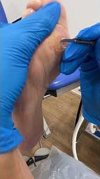 Plantar Callus and Corns | Callus Reduction and Corn Removal #foothealth#podiatry #footcare #corn