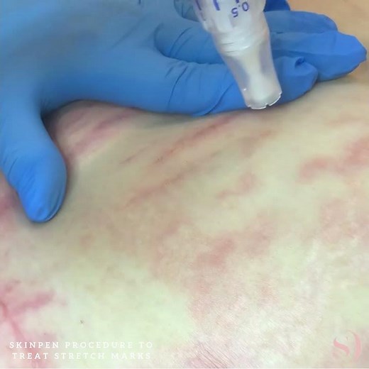 Skinpen (Microneedling) Procedure To Treat Stretch Marks